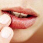 woman touching lip with cold sores